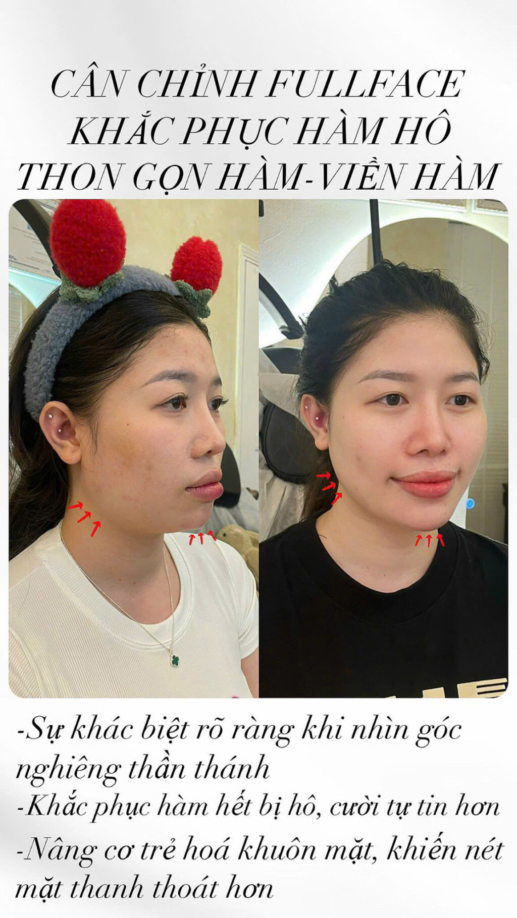 nang tam ve dep tai emybeautyclinic voi dich vu filler botox va dao tao ky thuat vien chuyen nghiep 8