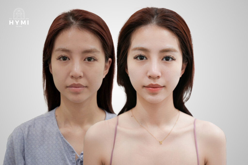 hymi prime tien phong don dau xu huong nang co tre hoa khong xam lan 2